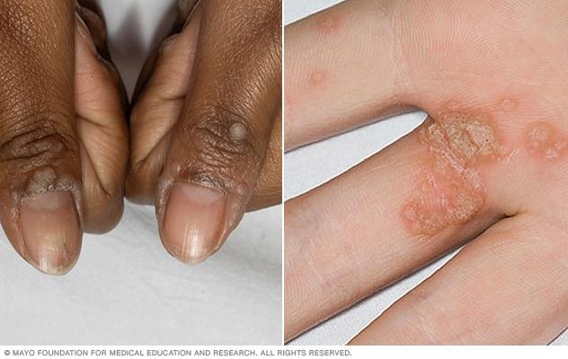 Common warts on hand
