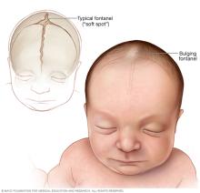 Typical and bulging soft spots, also known as fontanels, of a baby's skull