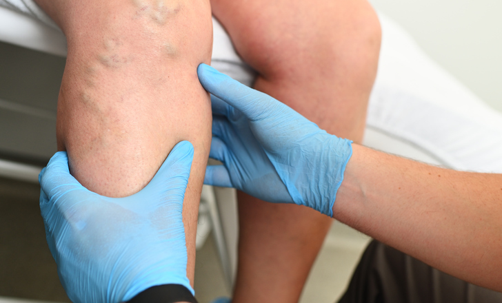 A patient getting treatment for lymphedema at Altru.