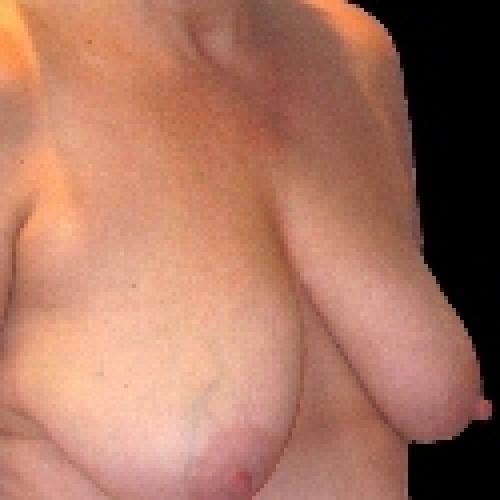 Breast Lift - Before