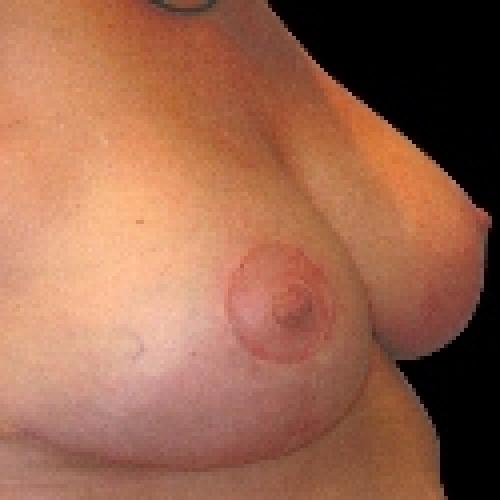 Breast Lift - After