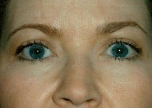 Eyelid Lift - After