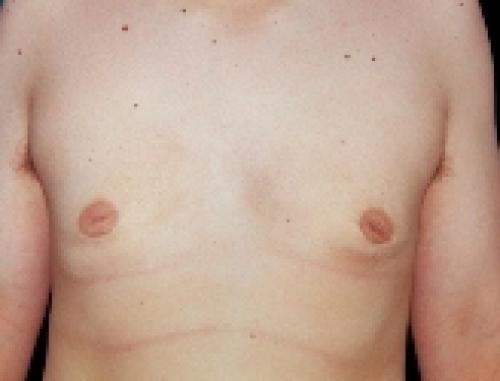 Male Breast Reduction - After