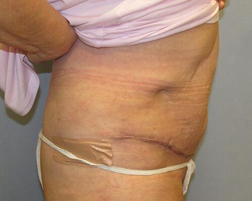 Abdominoplasty Side View - After