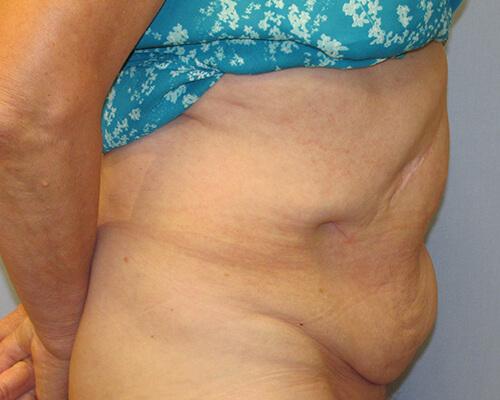 Abdominoplasty Side View - Before