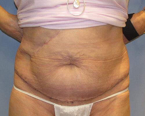 Abdominoplasty Front View - After