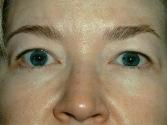 Eyelid Lift - Before