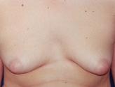 Male Breast Reduction - Before