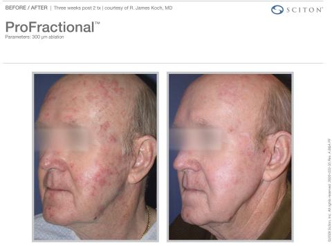 Profractional Before & After