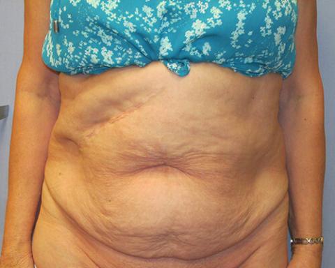Abdominoplasty Front View - Before