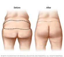 Buttocks shown before and after a buttock lift