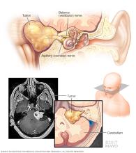 Vestibular schwannoma (acoustic neuroma)