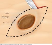 Excisional biopsy of the skin