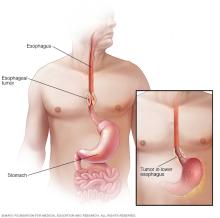 Illustration of esophageal cancer