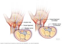 Carpal tunnel release procedure
