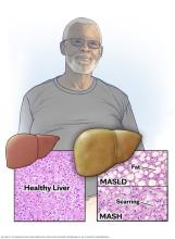 Microscopic view of healthy liver and nonalcoholic fatty liver
