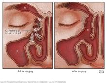 Illustration of endoscopic sinus surgery