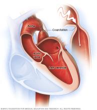 Illustration showing the heart and coarctation of the aorta