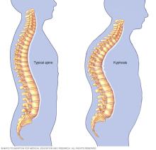 Illustration showing kyphosis