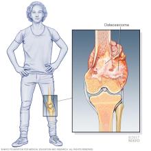 Illustration of a leg bone tumor at the knee, with an inset showing osteosarcoma growing from the end of the femur.