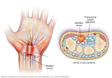 Pinched nerve in wrist