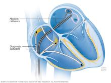 Illustration showing a type of cardiac ablation called pulmonary vein isolation