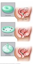 Three types of pessaries