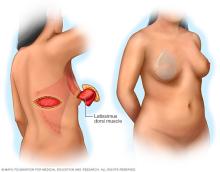 Before and after images of a pedicle lastissimus dorsi flap procedure for breast reconstruction.