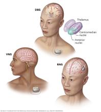 Vagus nerve stimulation, deep brain stimulation and responsive neurostimulation.