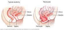 Typical anatomy and posterior vaginal prolapse (rectocele)