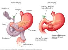 Illustration comparing the pancreas and nearby organs before and after surgery to remove a pancreatic tumor