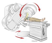 A person lying face up on a table while a linear accelerator rotates around the person’s head.