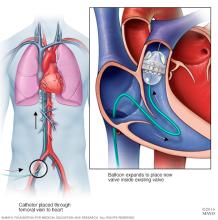 Pulmonary valve-in-valve replacement
