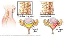 Herniated disk in the cervical spine