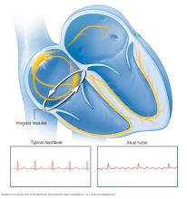 Illustration showing atrial flutter