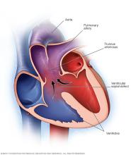Truncus arteriosus
