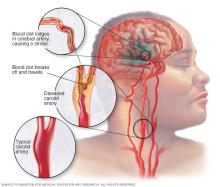 Ischemic stroke