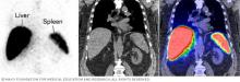 SPECT scan results