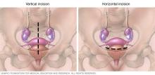 Illustration of vertical and horizontal abdominal hysterectomy incisions