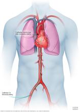 Catheterization for a coronary angiogram