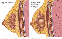 Illustration showing a breast and a fibrocystic breast