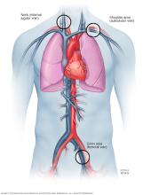 Illustration shows where catheters are placed for cardiac ablation