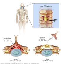Illustration of cervical laminectomy