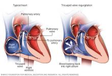 A typical heart compared with a heart showing tricuspid valve regurgitation.