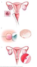 Illustration showing IVF process, including egg retrieval, fertilization and embryo transfer