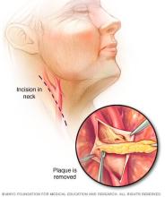 Steps in carotid endarterectomy