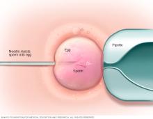 Illustration showing a single sperm injected into an egg during an ICSI procedure
