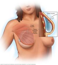 Illustration shows a tissue expander placed below the chest muscle as part of breast reconstruction with an implant.
