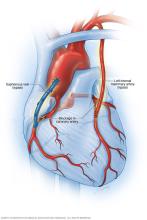 Illustration of coronary artery bypass surgery showing new blood vessel paths around a blocked heart artery.