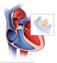 Illustration of a biological pulmonary valve